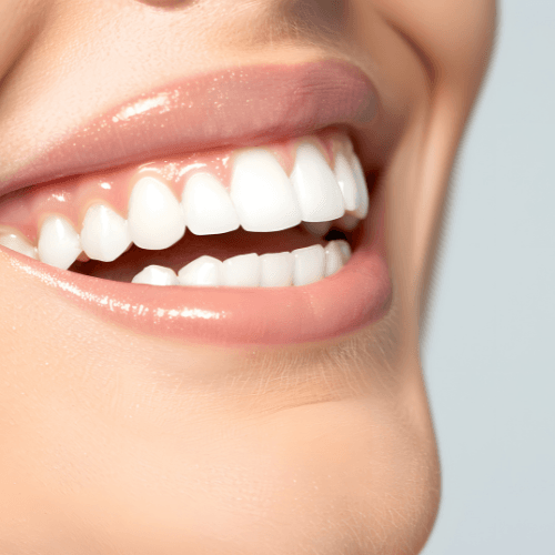 sbiancamento dentale