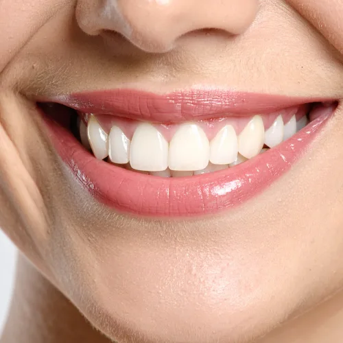 denti bianchi post trattamento