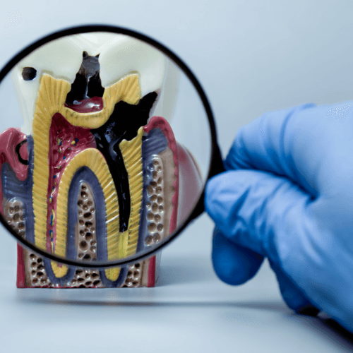 Carie profonda e devitalizzazione