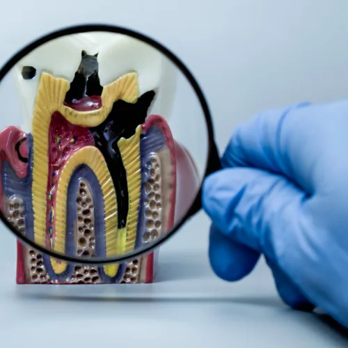 Carie profonda e devitalizzazione