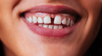 diastema