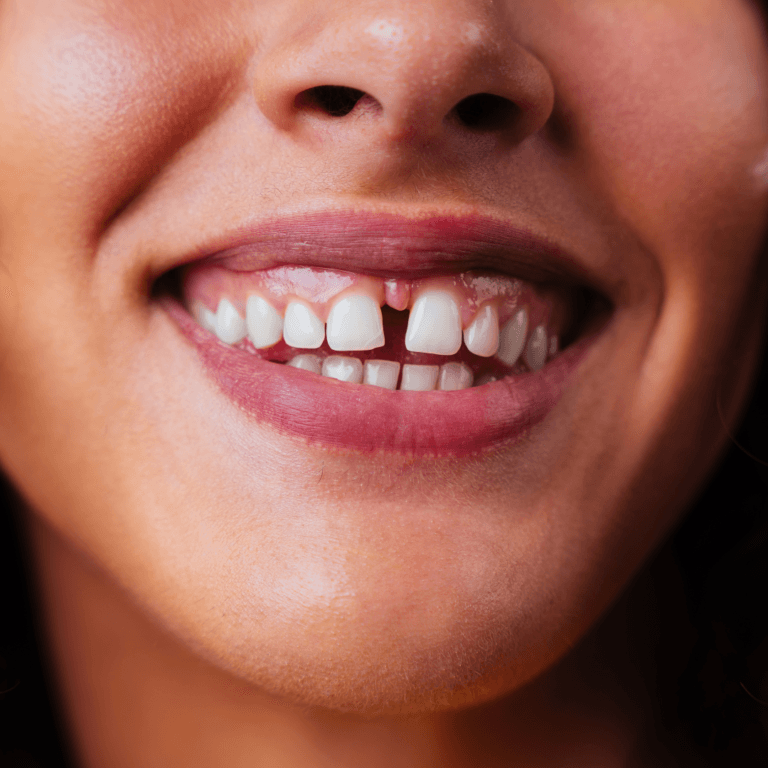 diastema